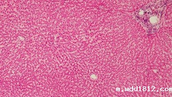 肝细胞变性的类型